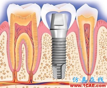 ansys對(duì)種植牙的仿真模擬ansys仿真分析圖片2